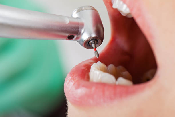 Best Chipped Tooth Repair Near Me  in Woodbury, NY